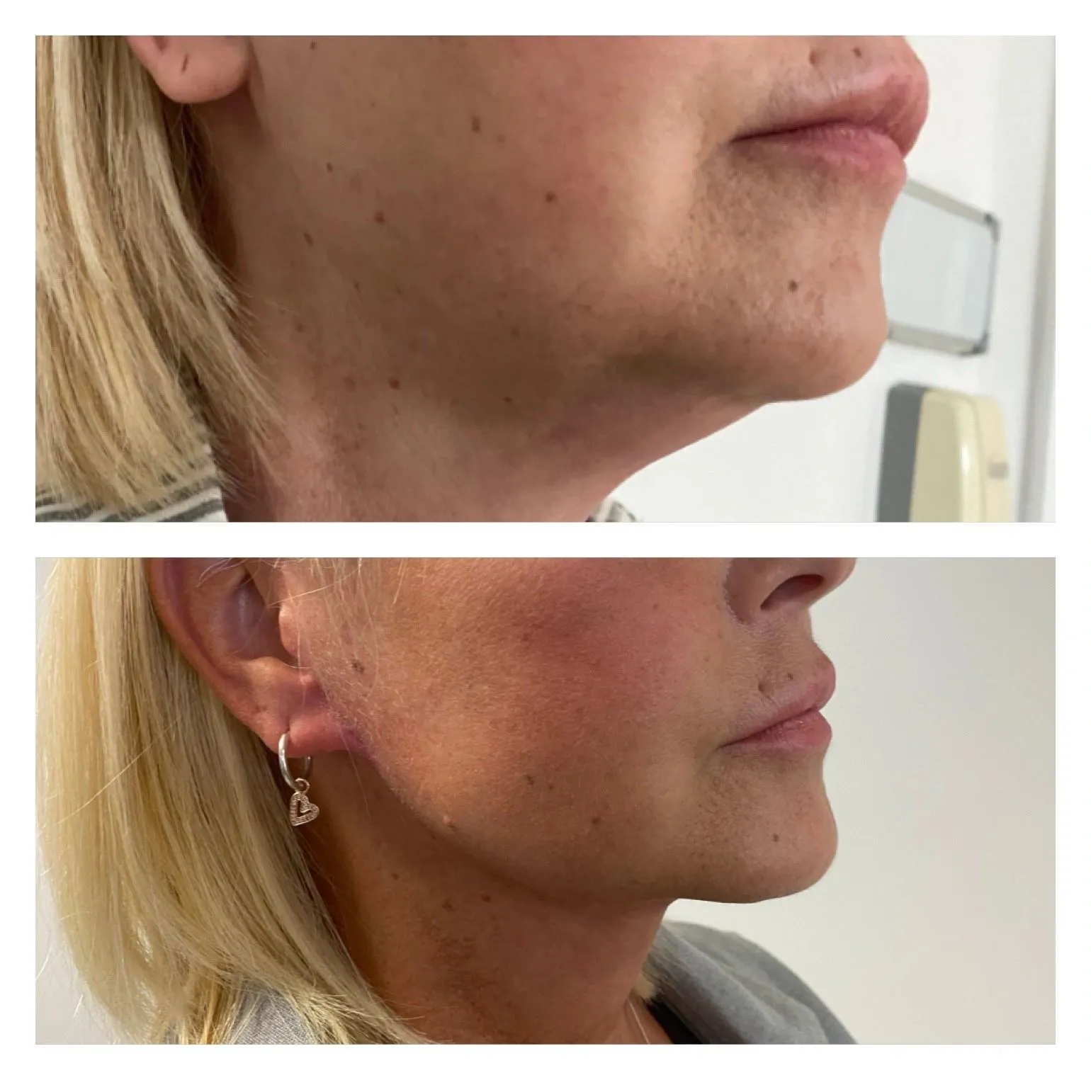Facelift before and after result 1 by Dr Amr Khalil, Manchester
