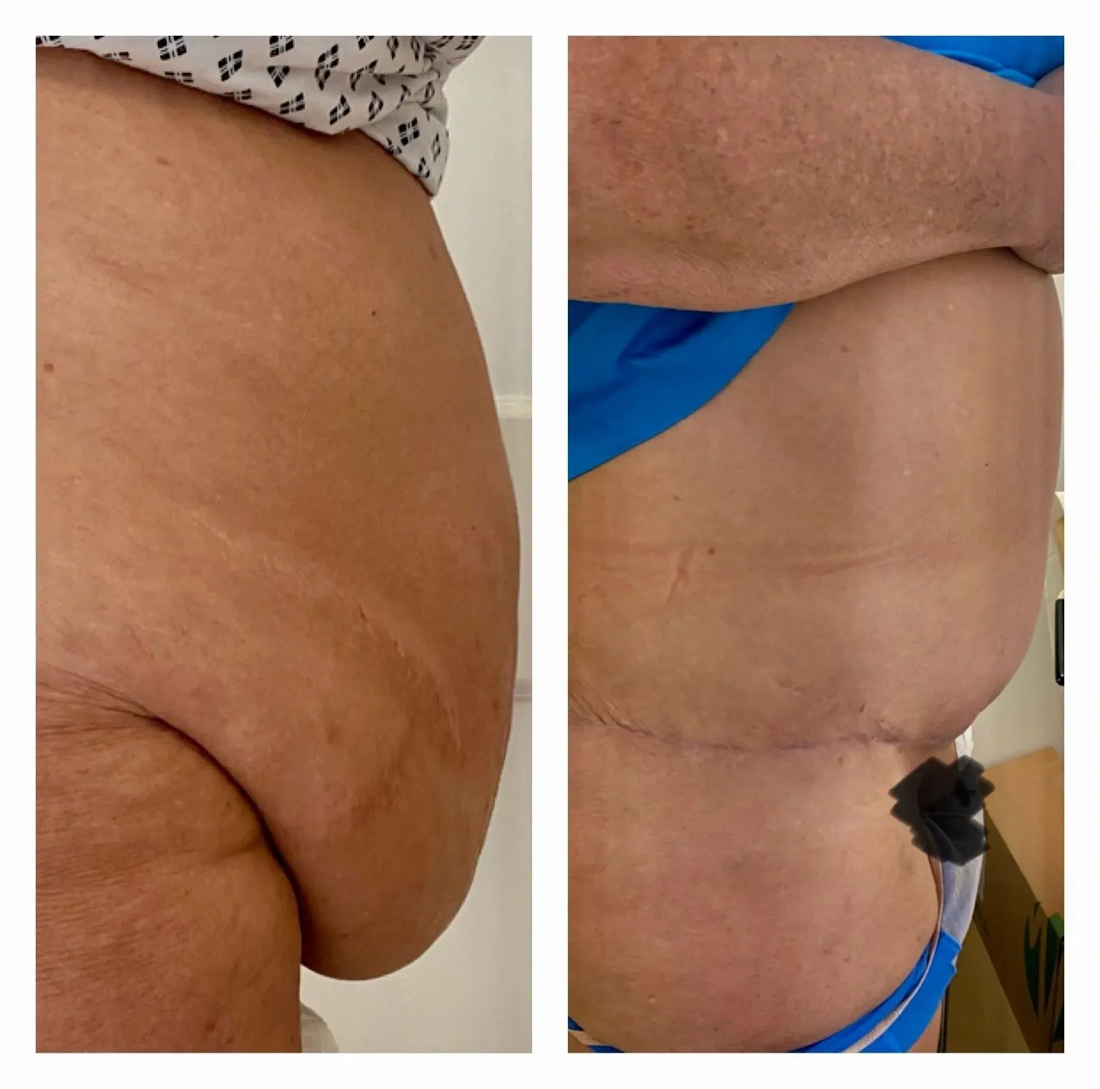 Abdominoplasty before and after result 1 by Dr Amr Khalil, Manchester