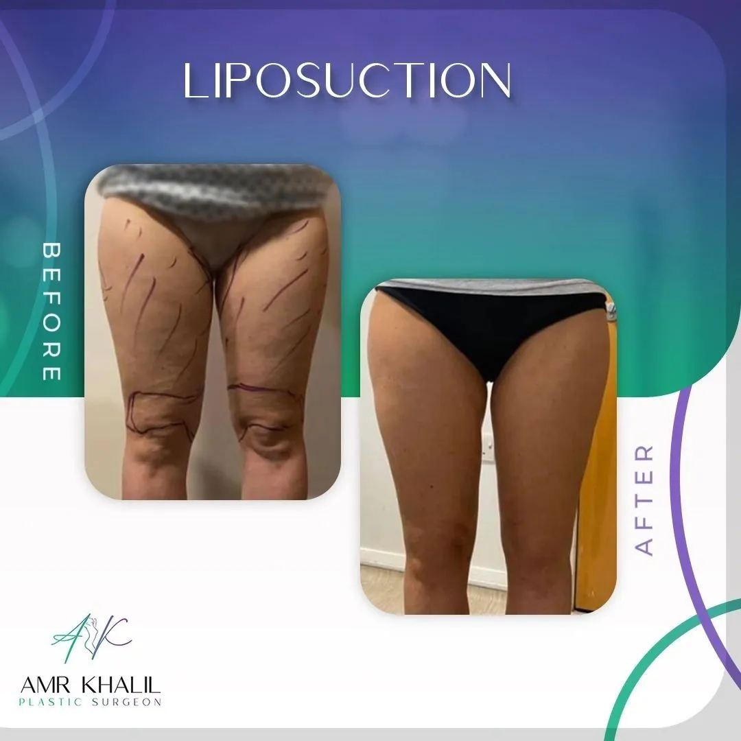 Liposuction before and after result 1 by Dr Amr Khalil, Manchester