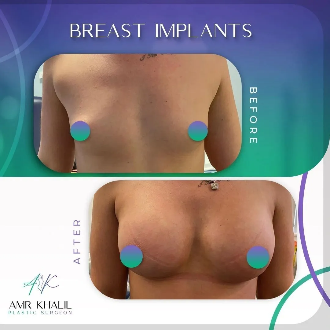 Breast Augmentation before and after result 1 by Dr Amr Khalil, Manchester