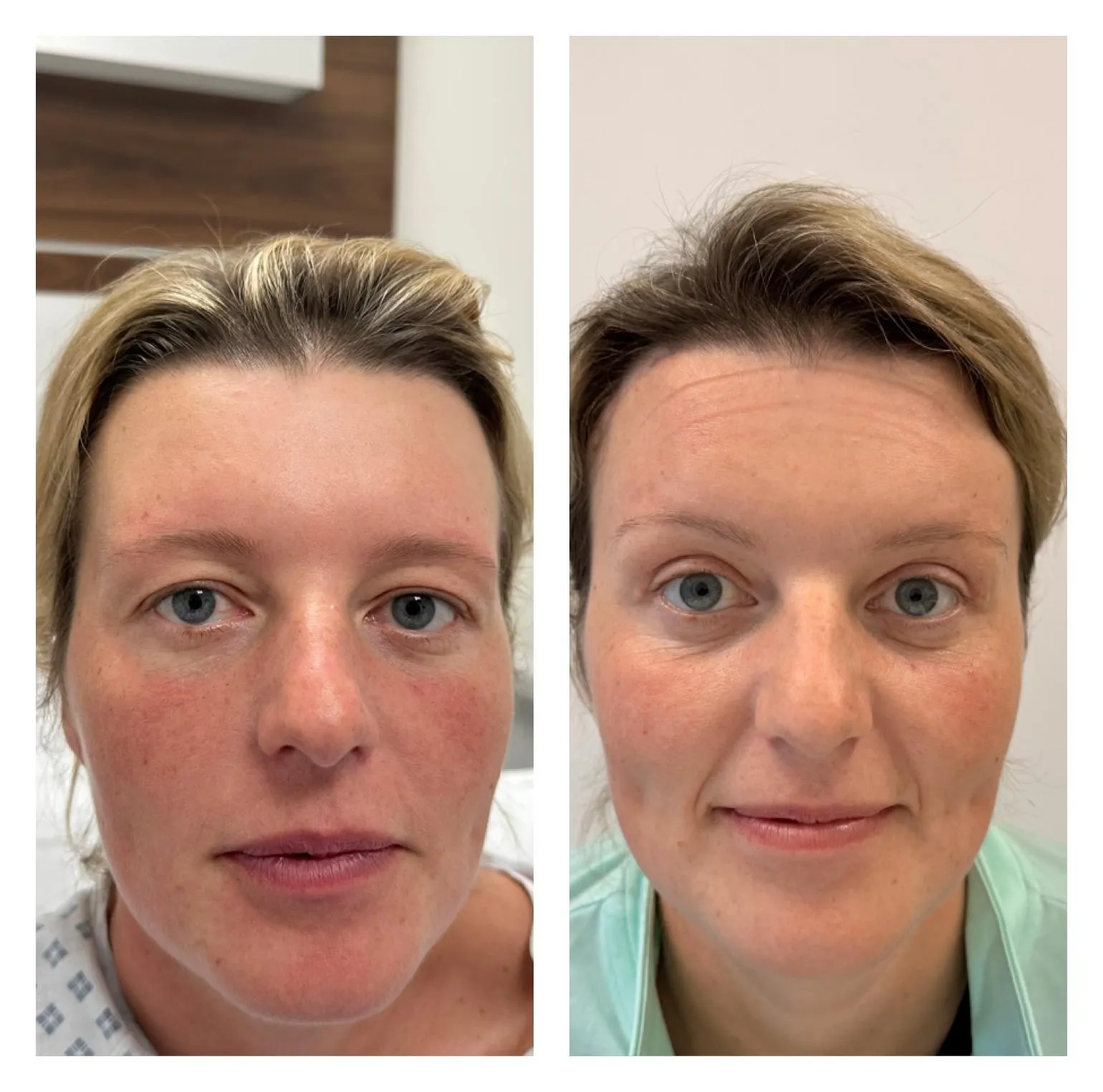 Upper & Lower Eyelids Lift before and after result 2 by Dr Amr Khalil, Manchester