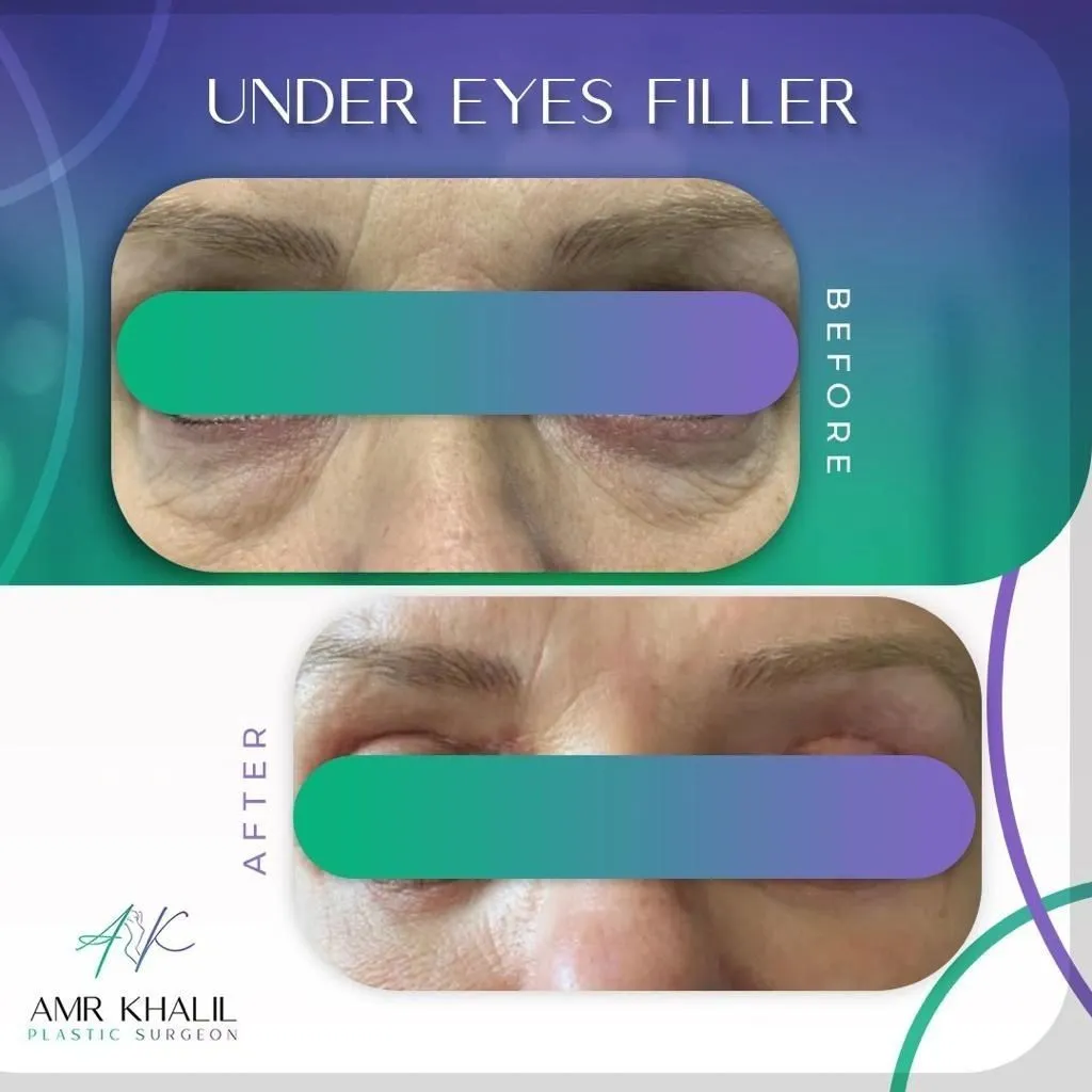 Upper & Lower Eyelids Lift before and after result 1 by Dr Amr Khalil, Manchester