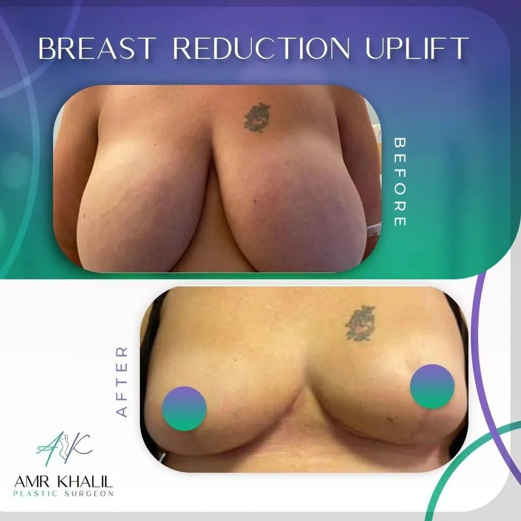 Breast Uplift before and after result 1 by Dr Amr Khalil, Manchester