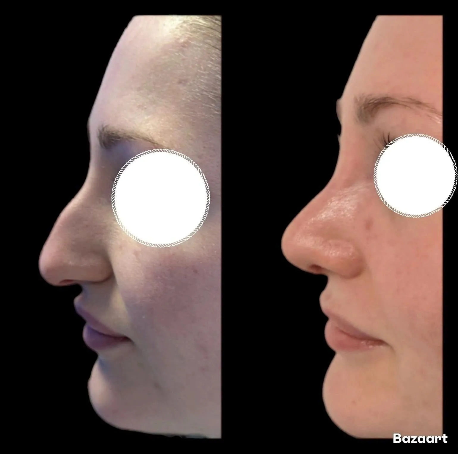 Rhinoplasty before and after result 2 by Dr Amr Khalil, Manchester
