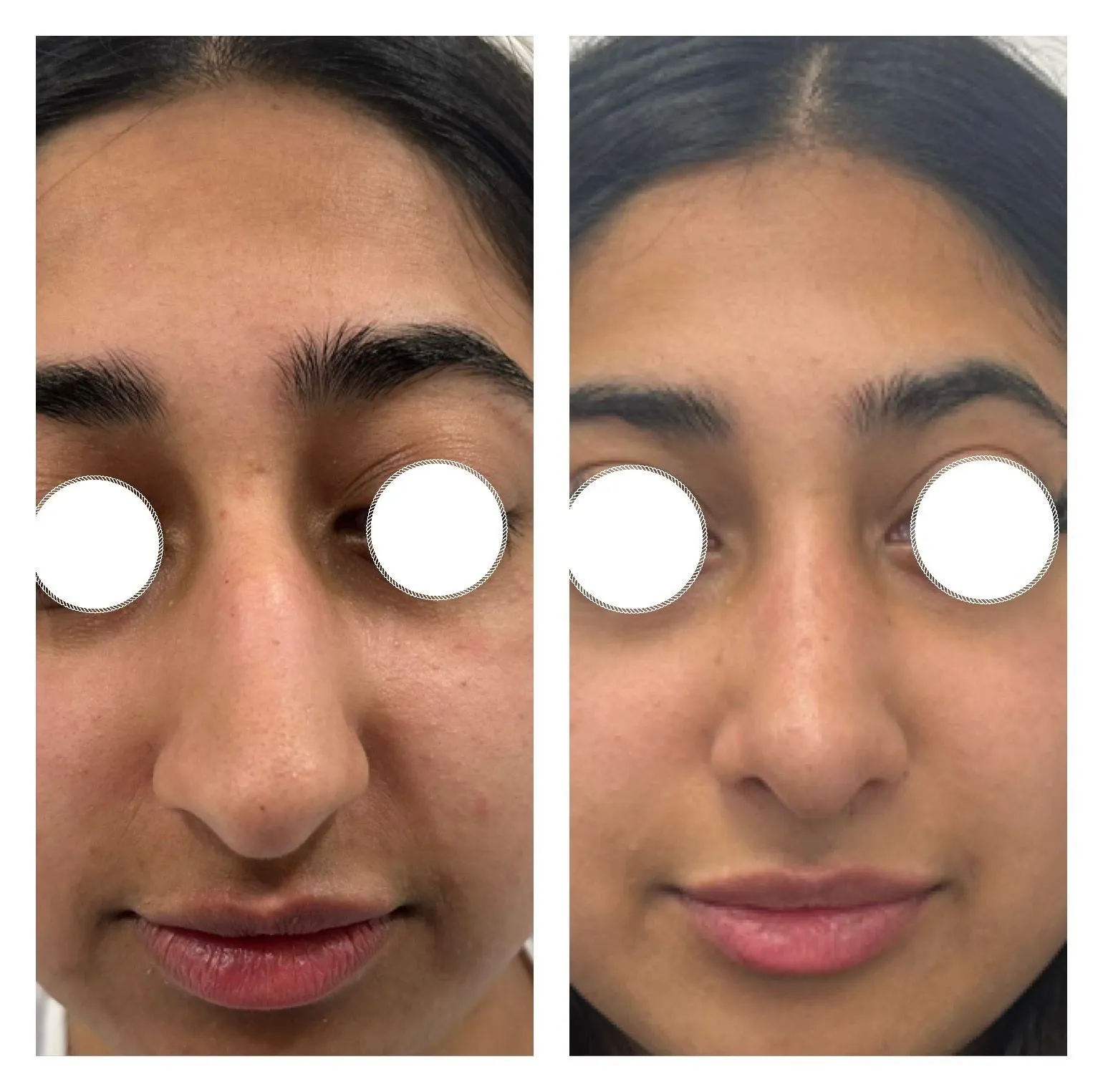 Rhinoplasty before and after result 17 by Dr Amr Khalil, Manchester