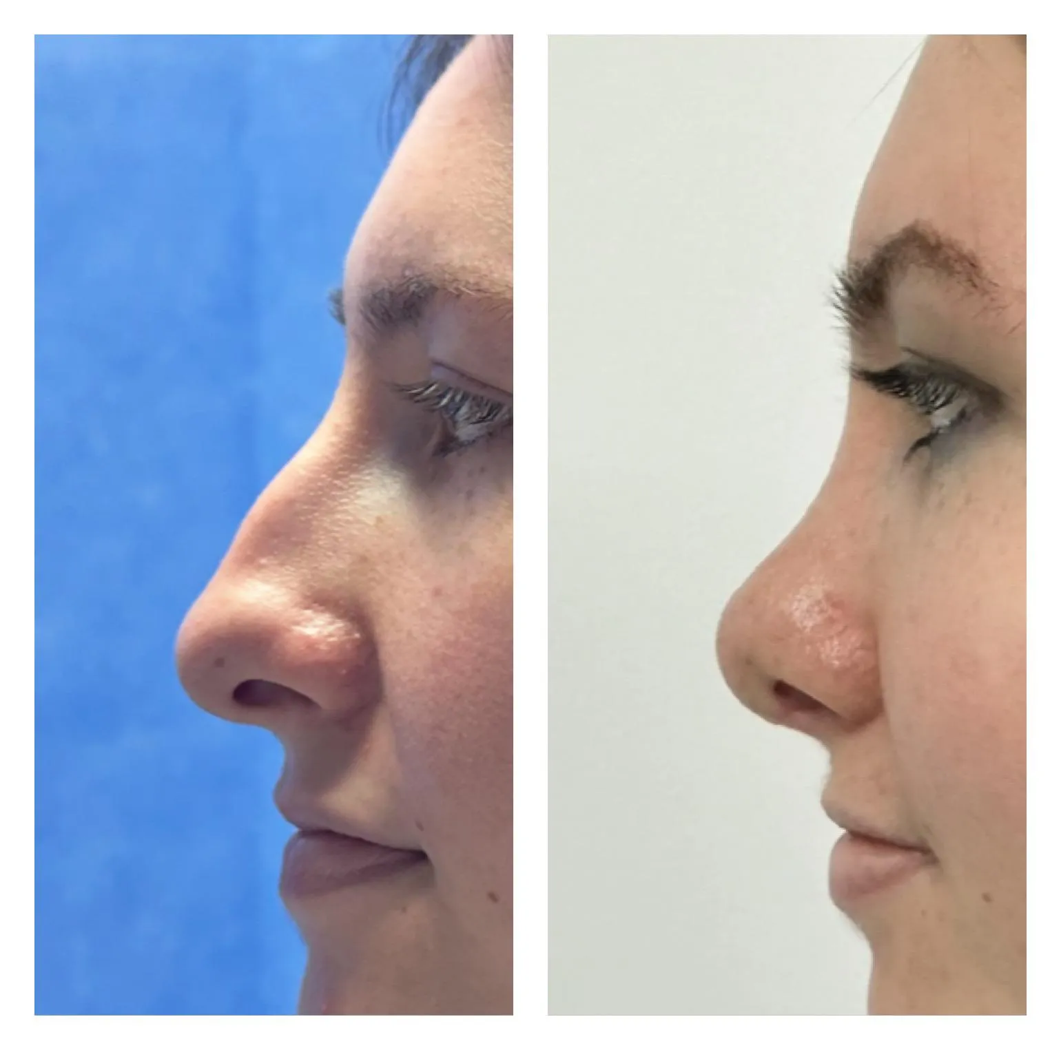 Rhinoplasty before and after result 18 by Dr Amr Khalil, Manchester