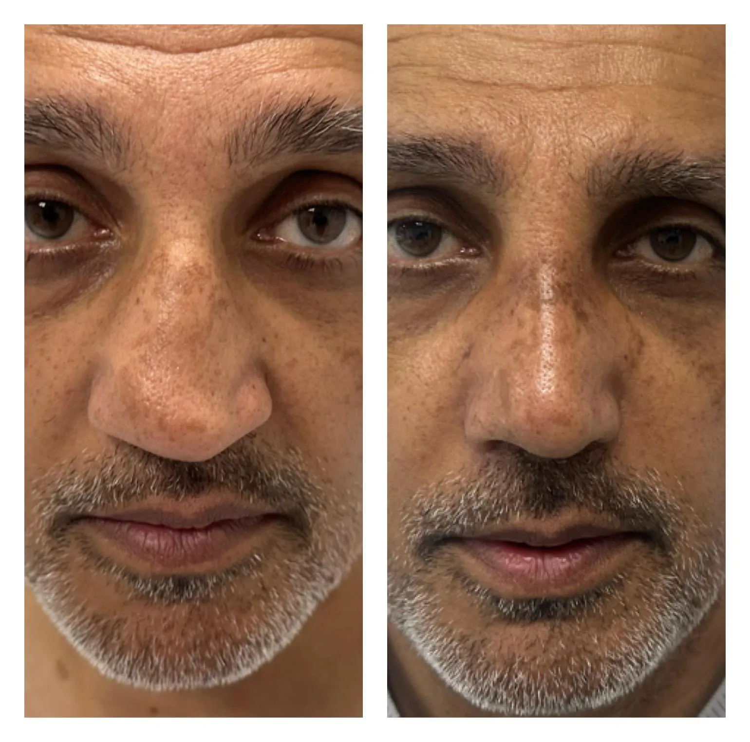 Rhinoplasty before and after result 19 by Dr Amr Khalil, Manchester