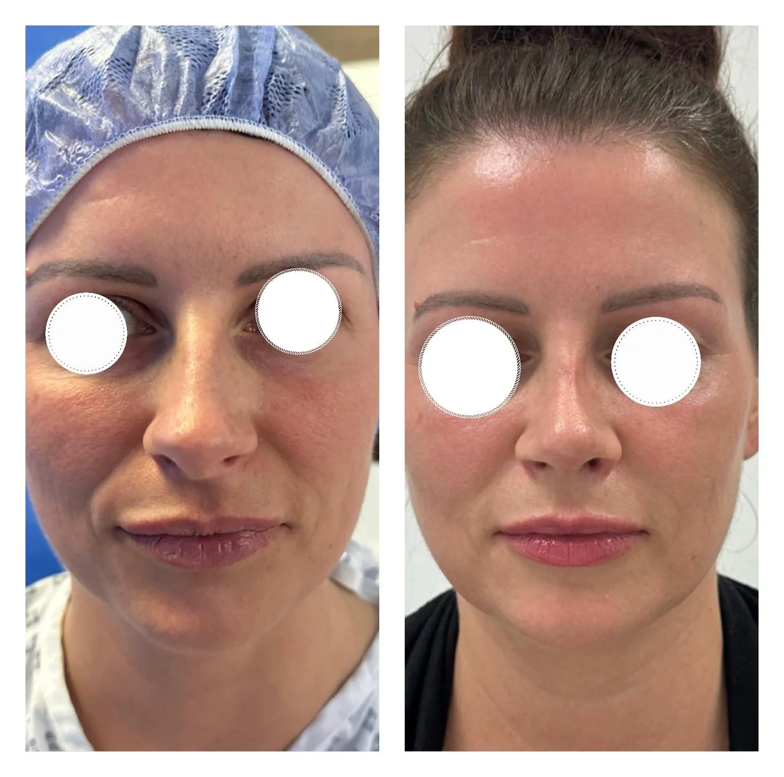 Rhinoplasty before and after result 20 by Dr Amr Khalil, Manchester