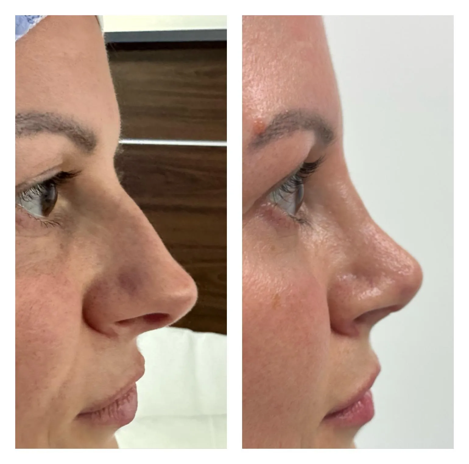 Rhinoplasty before and after result 21 by Dr Amr Khalil, Manchester