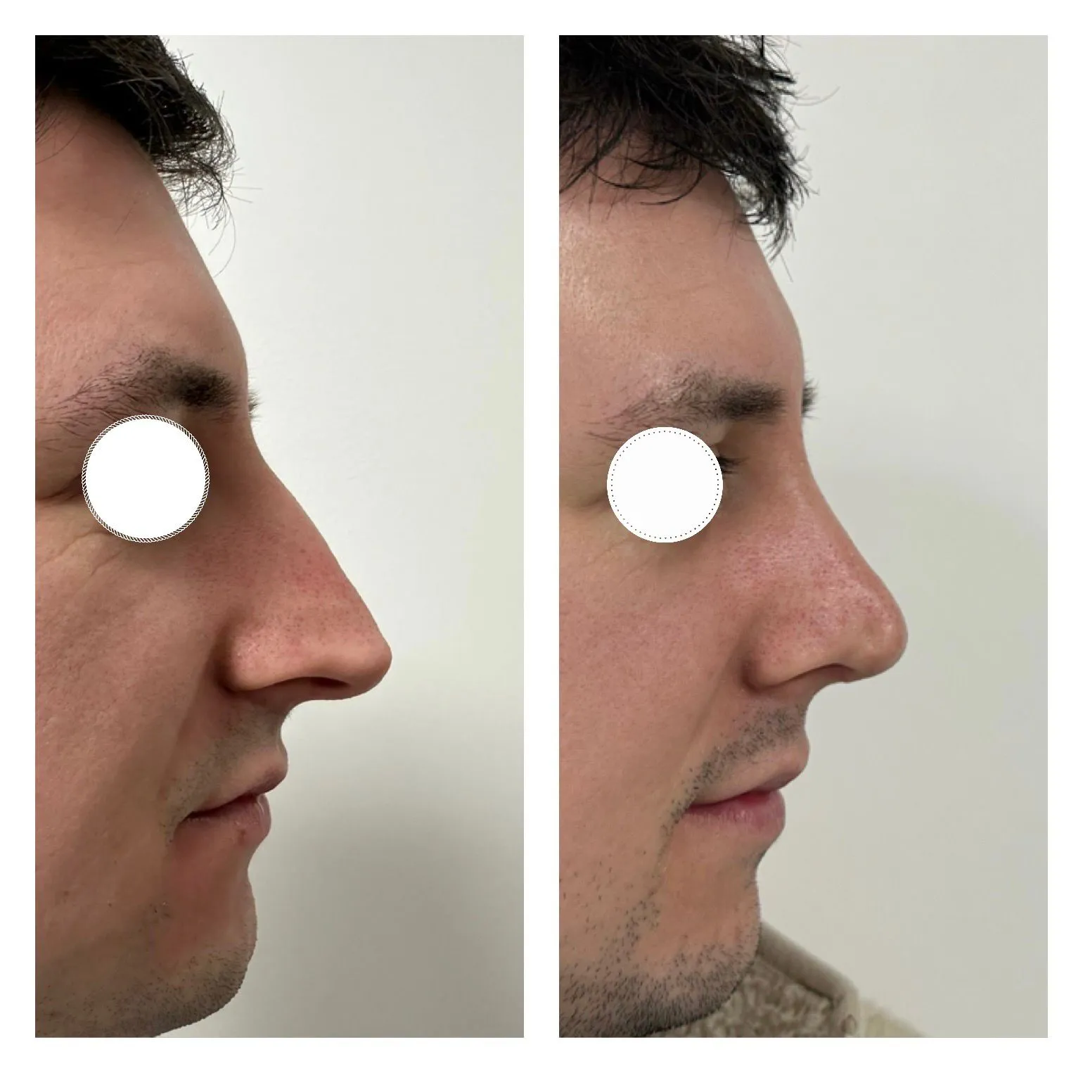 Rhinoplasty before and after result 22 by Dr Amr Khalil, Manchester