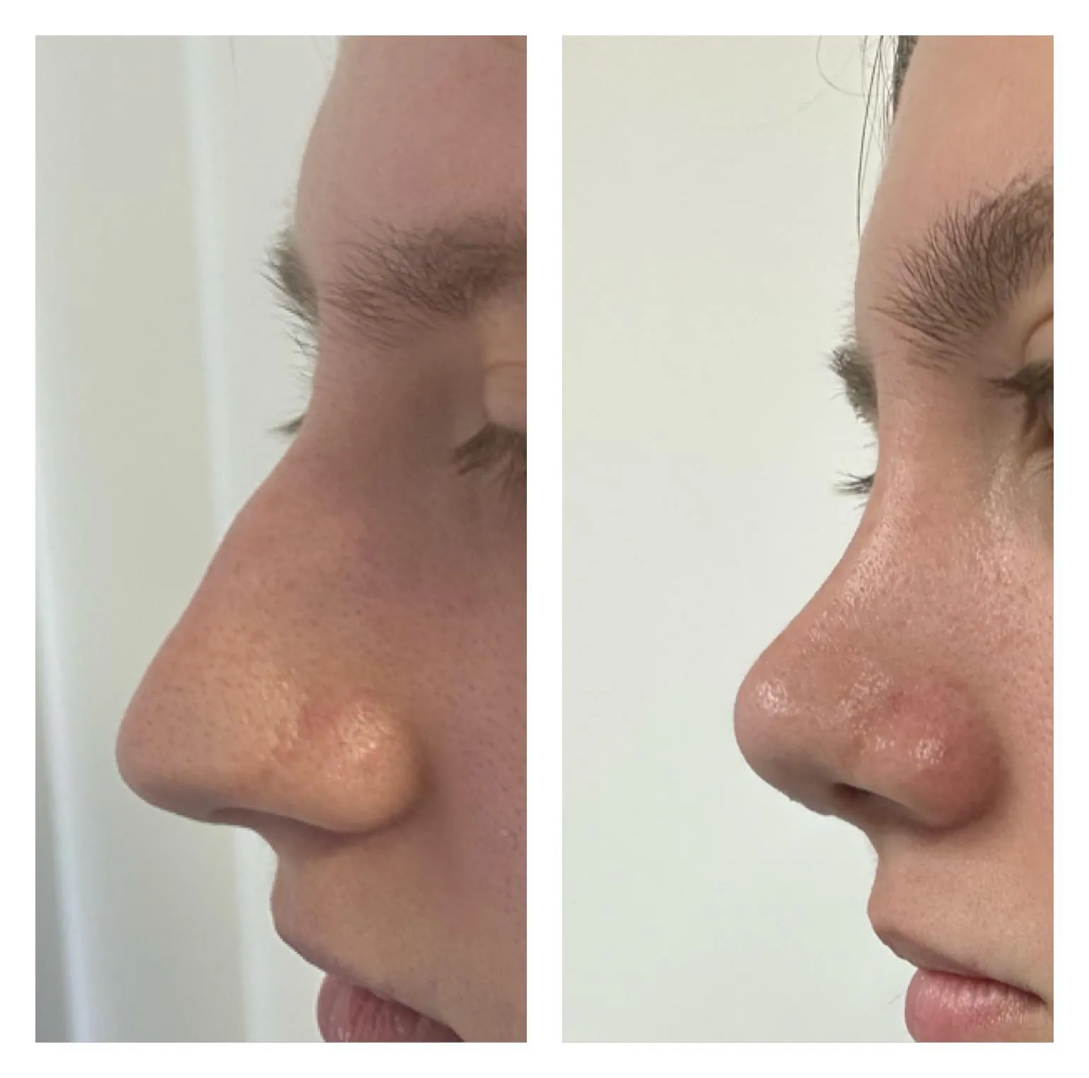 Rhinoplasty before and after result 23 by Dr Amr Khalil, Manchester