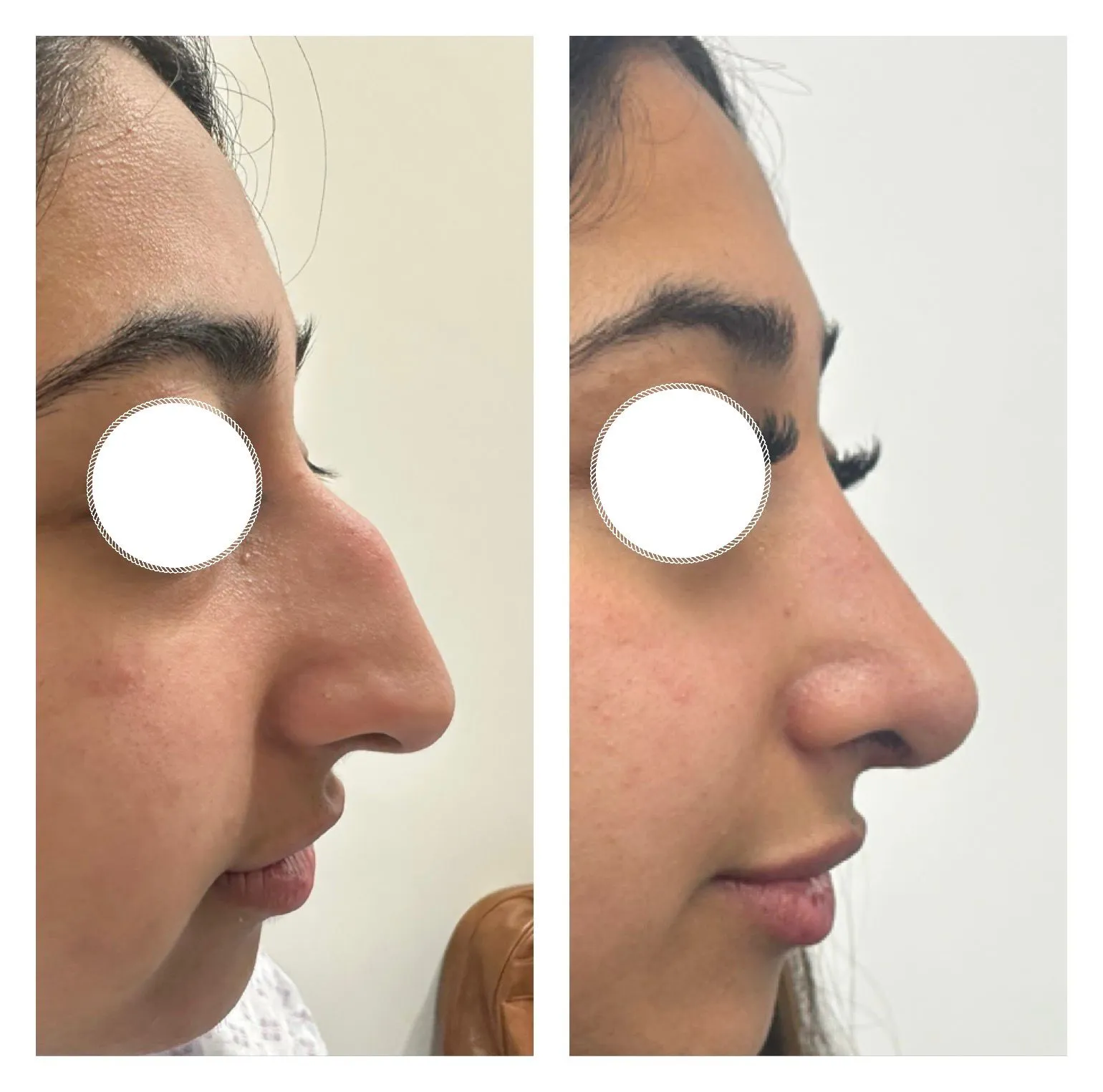 Rhinoplasty before and after result 24 by Dr Amr Khalil, Manchester