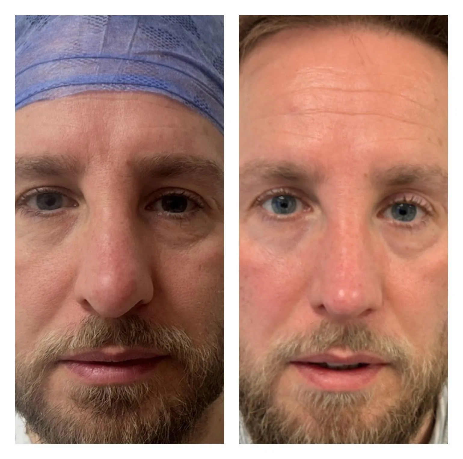 Rhinoplasty before and after result 25 by Dr Amr Khalil, Manchester