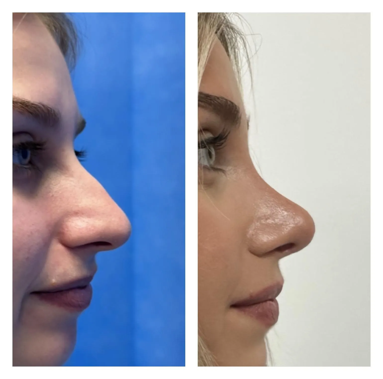 Rhinoplasty before and after result 26 by Dr Amr Khalil, Manchester