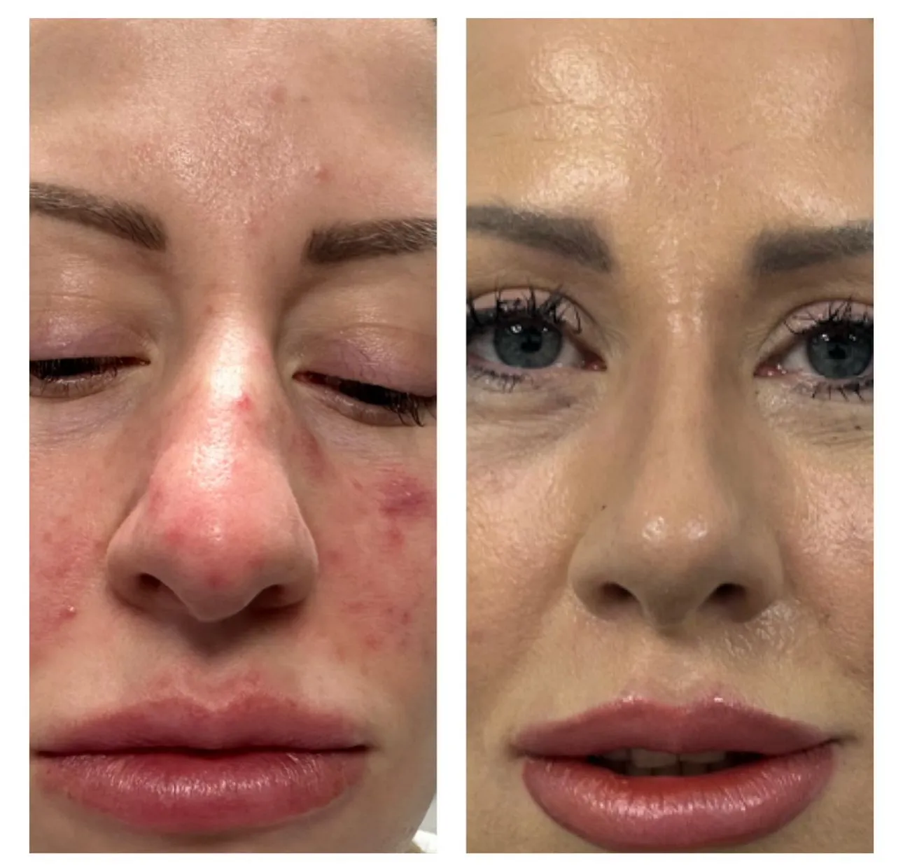 Rhinoplasty before and after result 3 by Dr Amr Khalil, Manchester