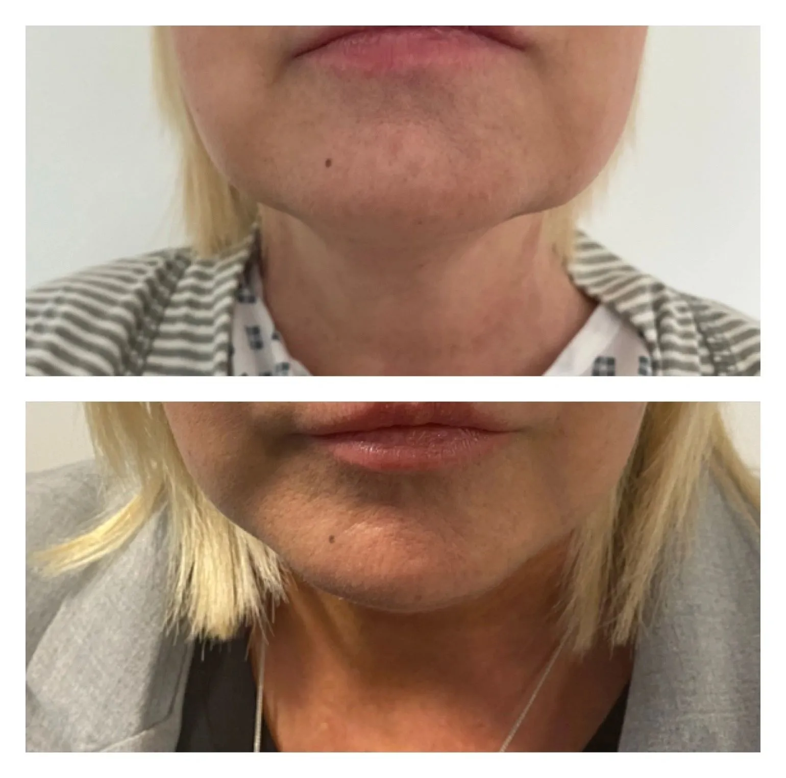 Facelift before and after result 2 by Dr Amr Khalil, Manchester