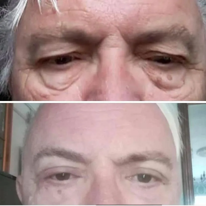 Upper & Lower Eyelids Lift before and after result 3 by Dr Amr Khalil, Manchester
