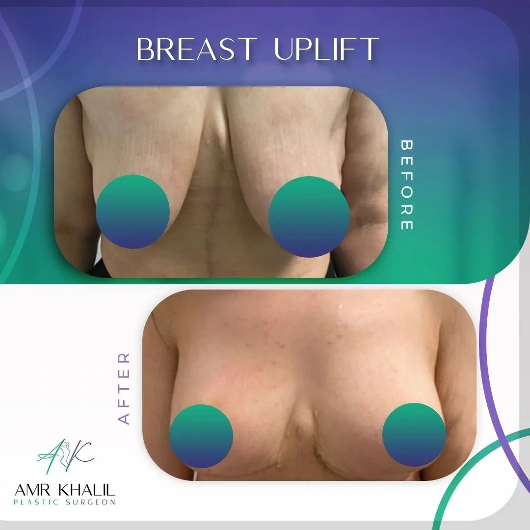 Breast Uplift before and after result 2 by Dr Amr Khalil, Manchester