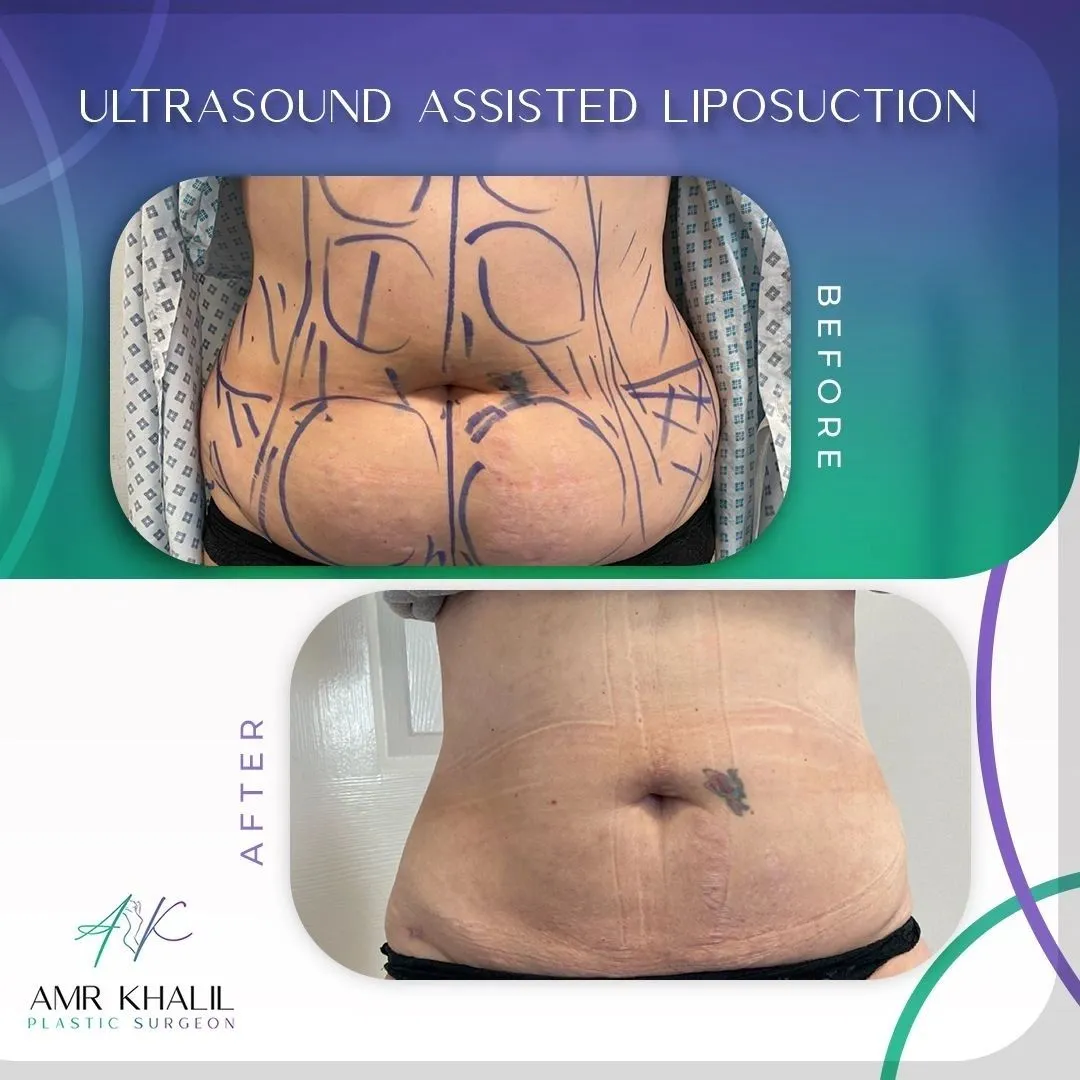 Liposuction before and after result 2 by Dr Amr Khalil, Manchester