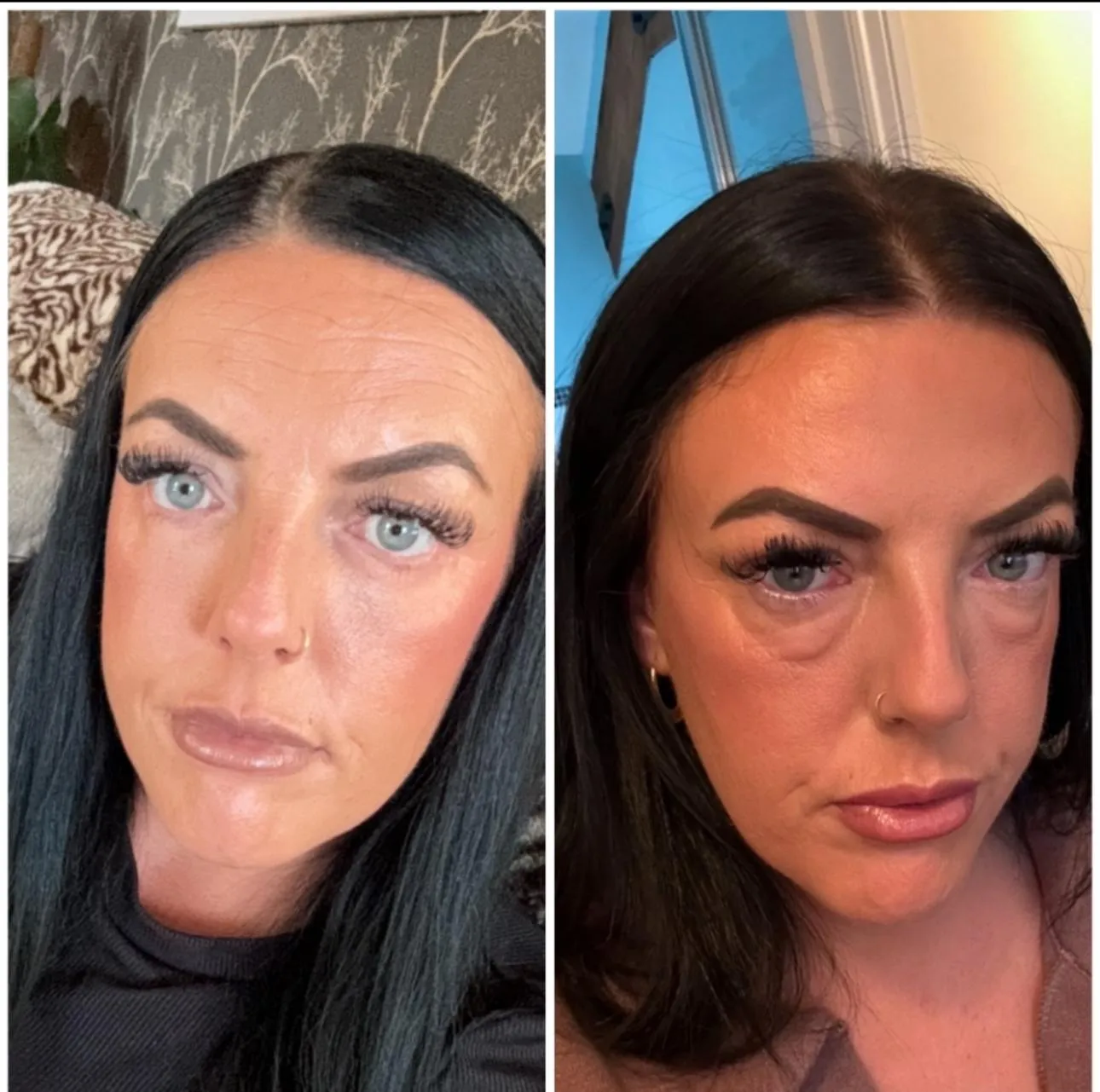 Upper & Lower Eyelids Lift before and after result 4 by Dr Amr Khalil, Manchester