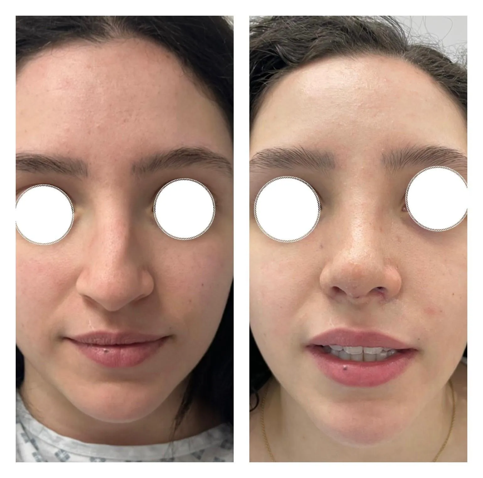 Rhinoplasty before and after result 27 by Dr Amr Khalil, Manchester