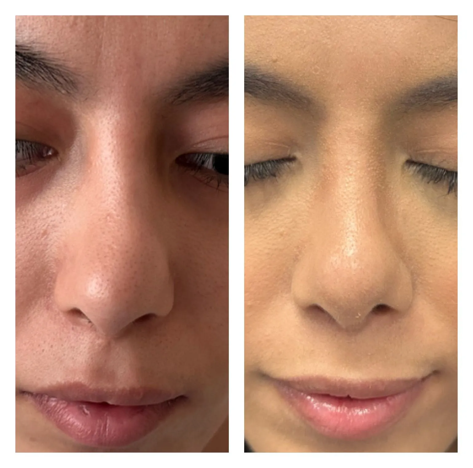 Rhinoplasty before and after result 28 by Dr Amr Khalil, Manchester