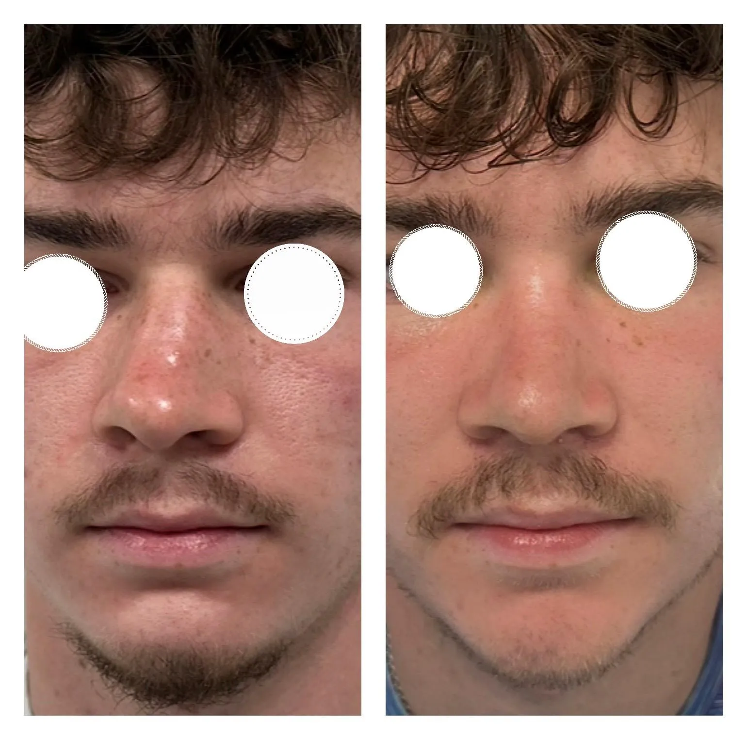 Rhinoplasty before and after result 29 by Dr Amr Khalil, Manchester