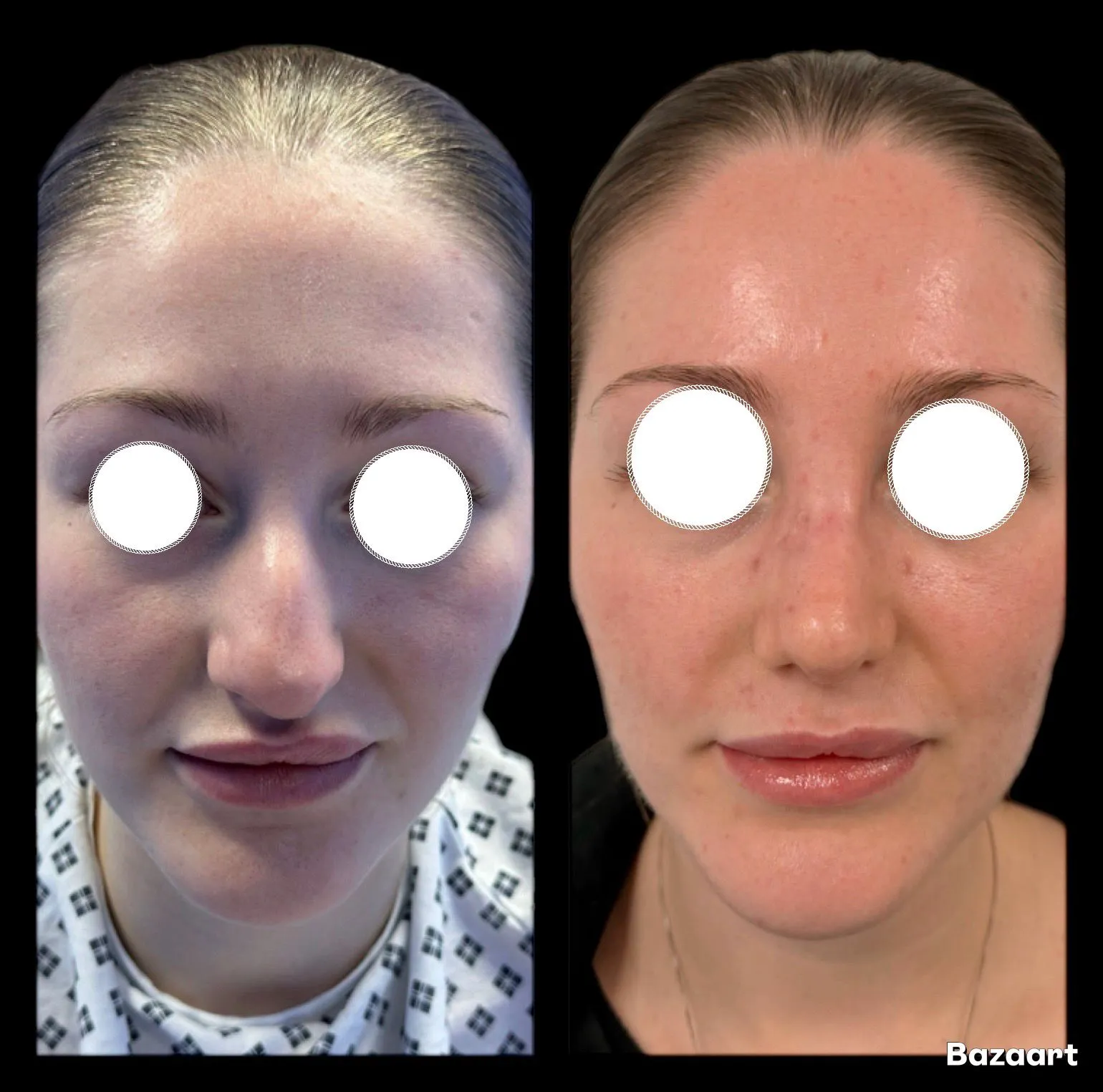Rhinoplasty before and after result 30 by Dr Amr Khalil, Manchester