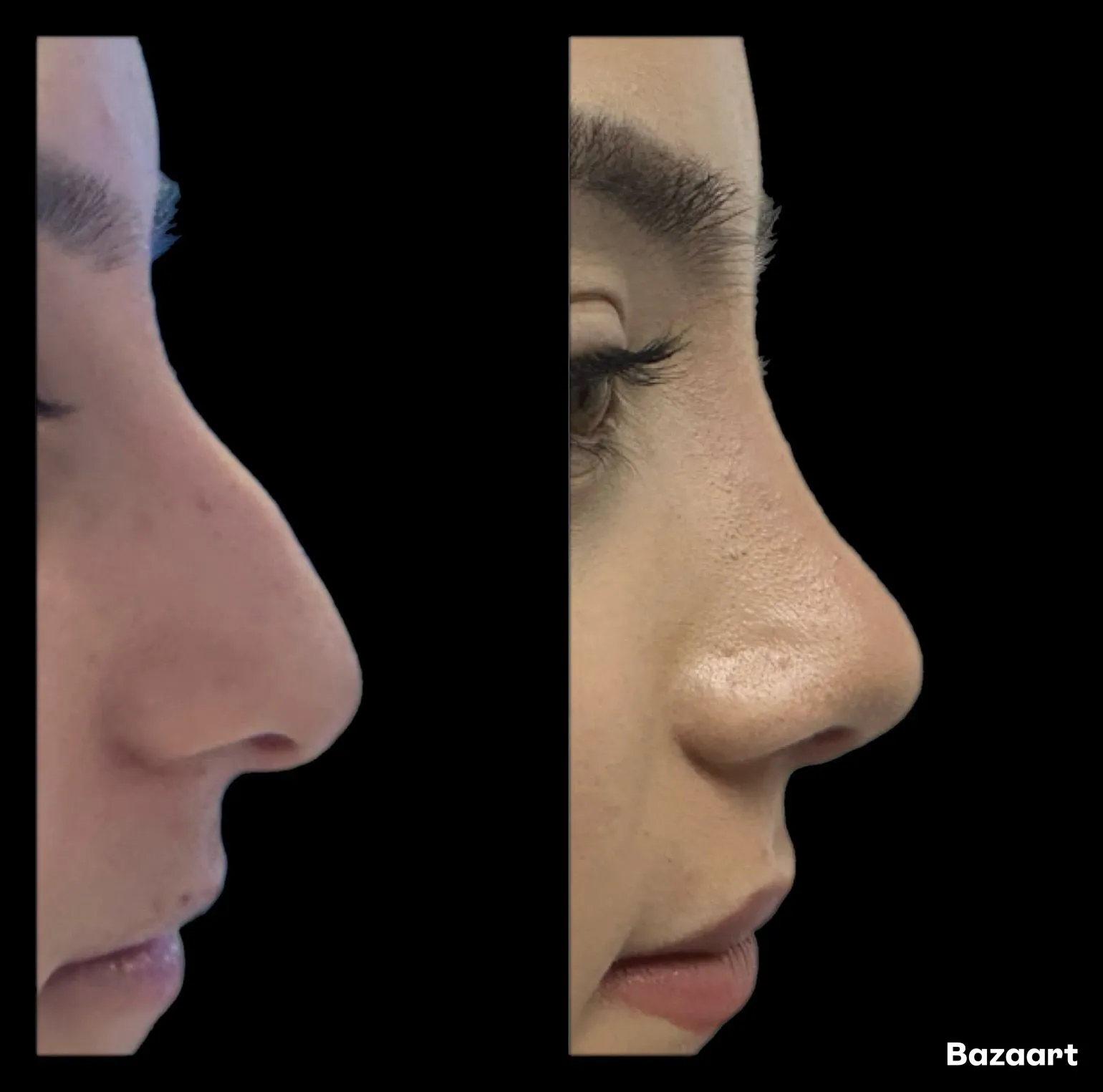 Rhinoplasty before and after result 31 by Dr Amr Khalil, Manchester