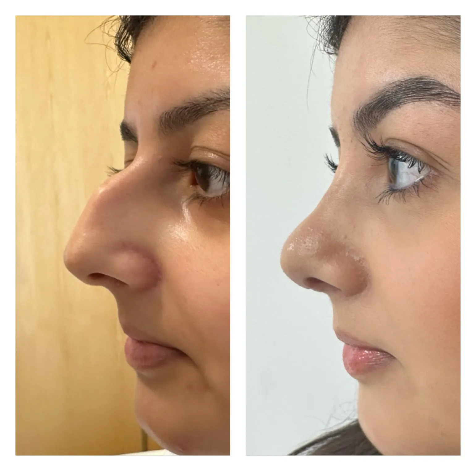 Rhinoplasty before and after result 32 by Dr Amr Khalil, Manchester