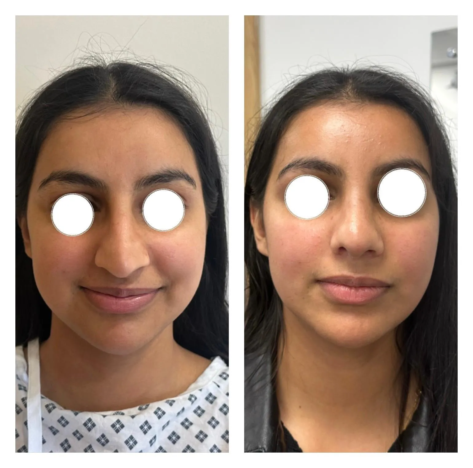 Rhinoplasty before and after result 33 by Dr Amr Khalil, Manchester