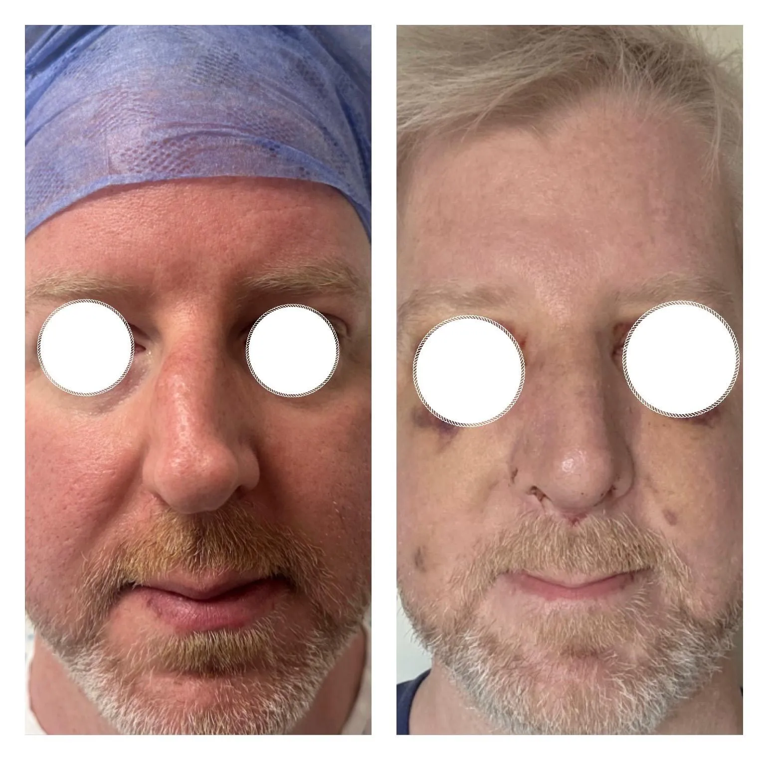 Rhinoplasty before and after result 34 by Dr Amr Khalil, Manchester