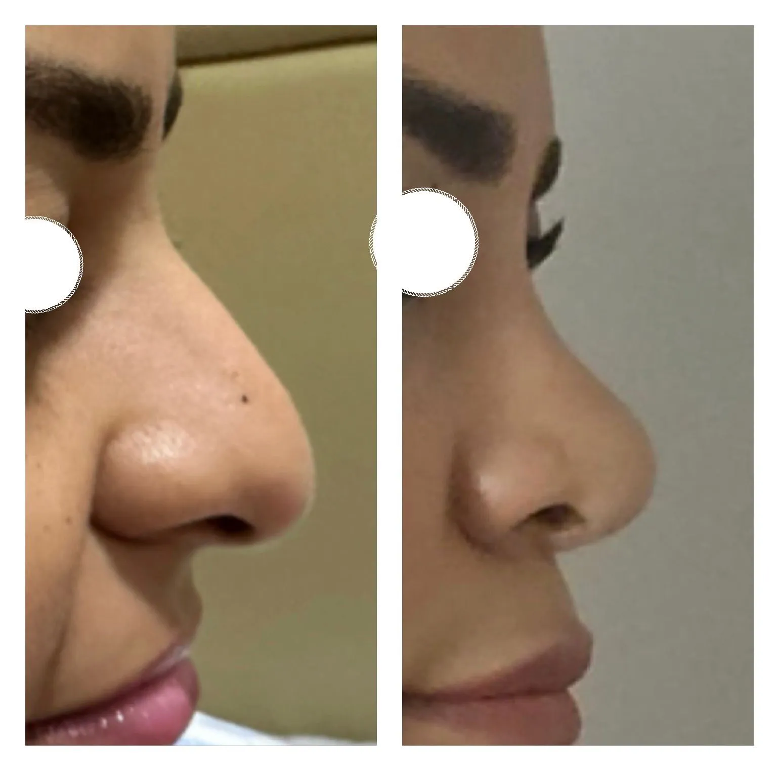 Rhinoplasty before and after result 35 by Dr Amr Khalil, Manchester