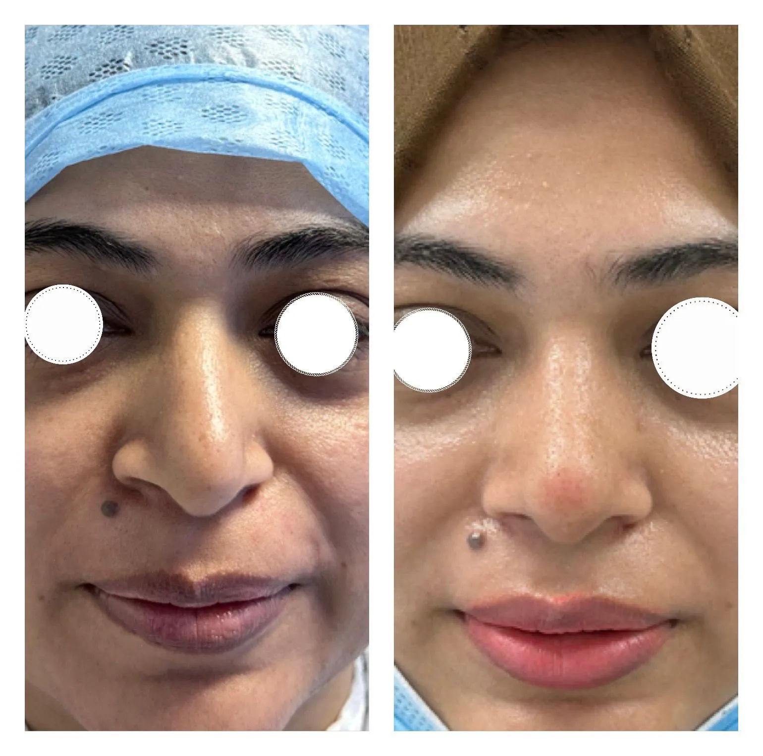 Rhinoplasty before and after result 36 by Dr Amr Khalil, Manchester