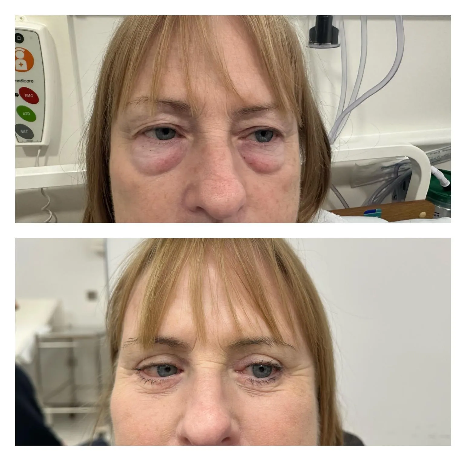 Upper & Lower Eyelids Lift before and after result 5 by Dr Amr Khalil, Manchester