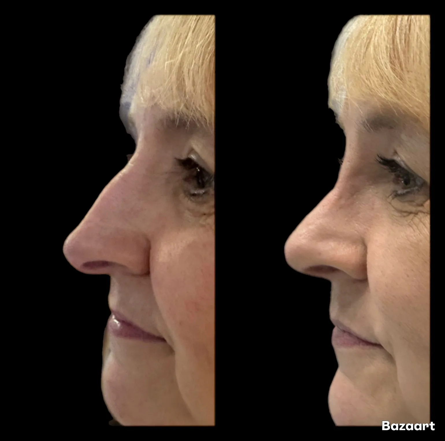 Rhinoplasty before and after result 5 by Dr Amr Khalil, Manchester