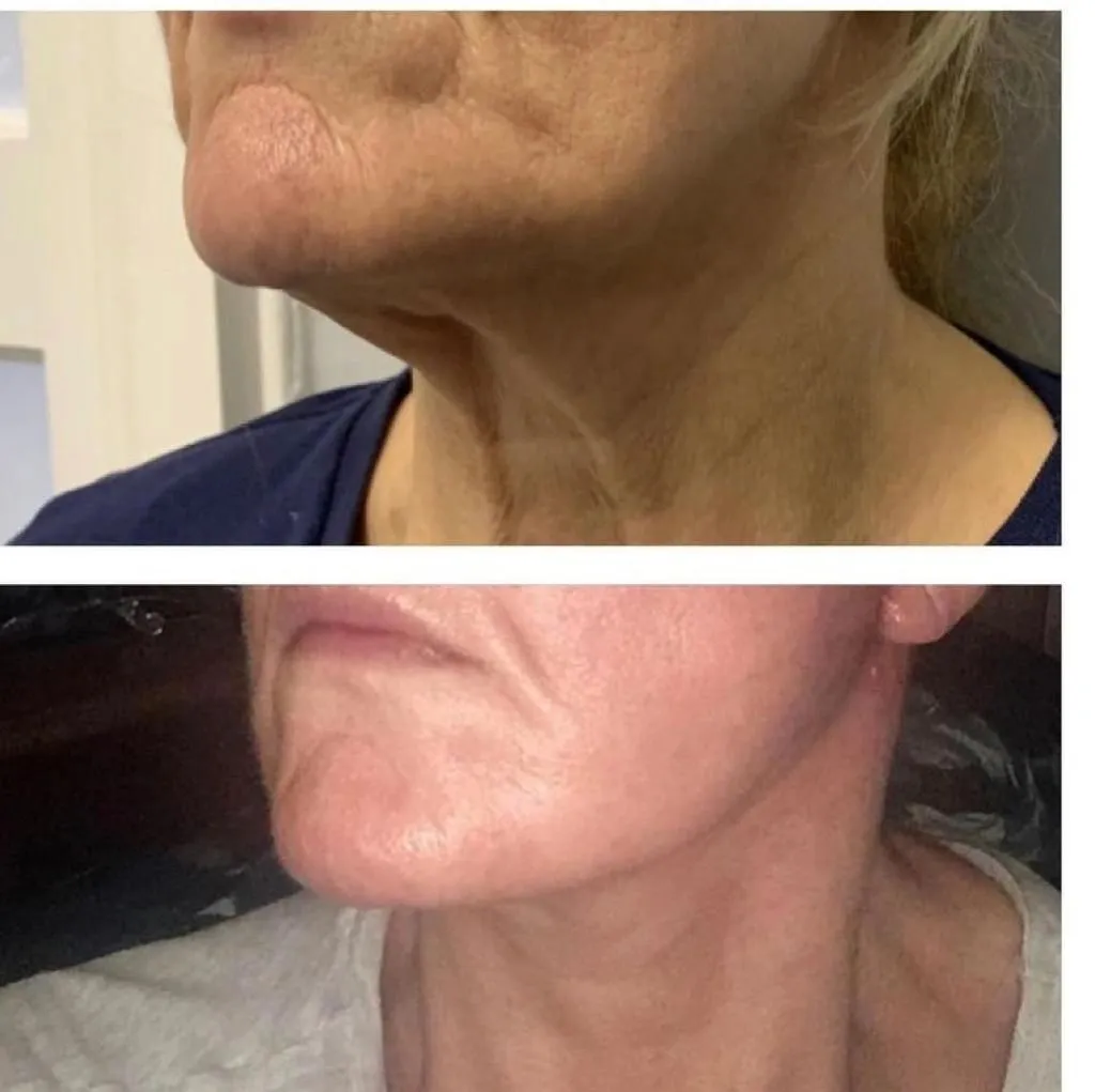 Facelift before and after result 3 by Dr Amr Khalil, Manchester