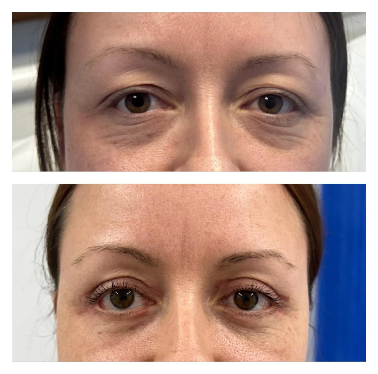 Upper & Lower Eyelids Lift before and after result 6 by Dr Amr Khalil, Manchester