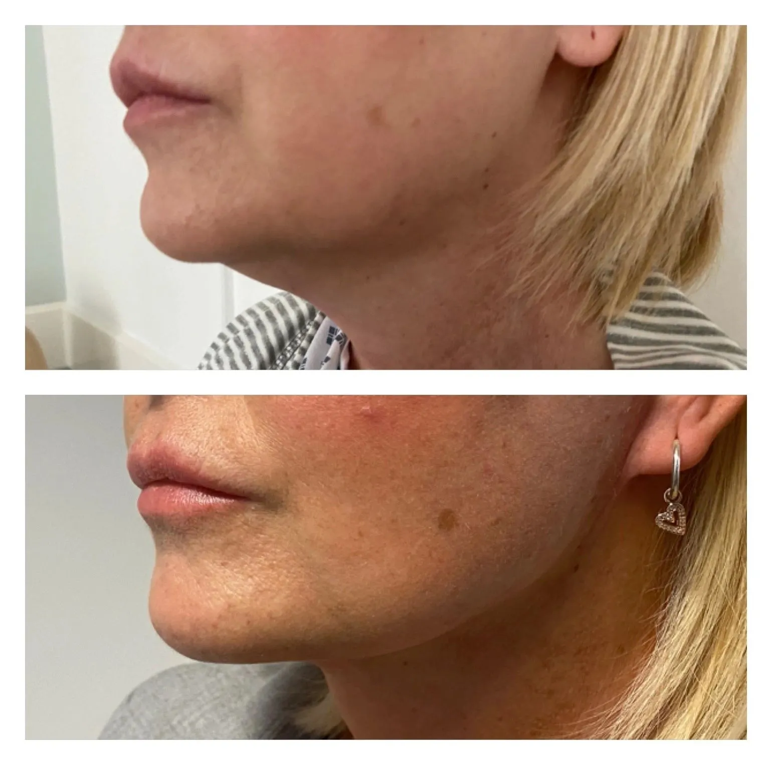 Facelift before and after result 4 by Dr Amr Khalil, Manchester