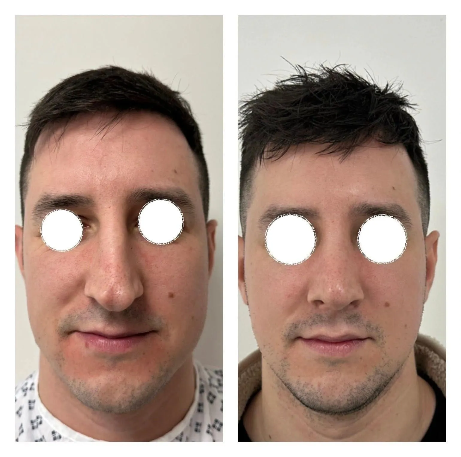 Rhinoplasty before and after result 8 by Dr Amr Khalil, Manchester