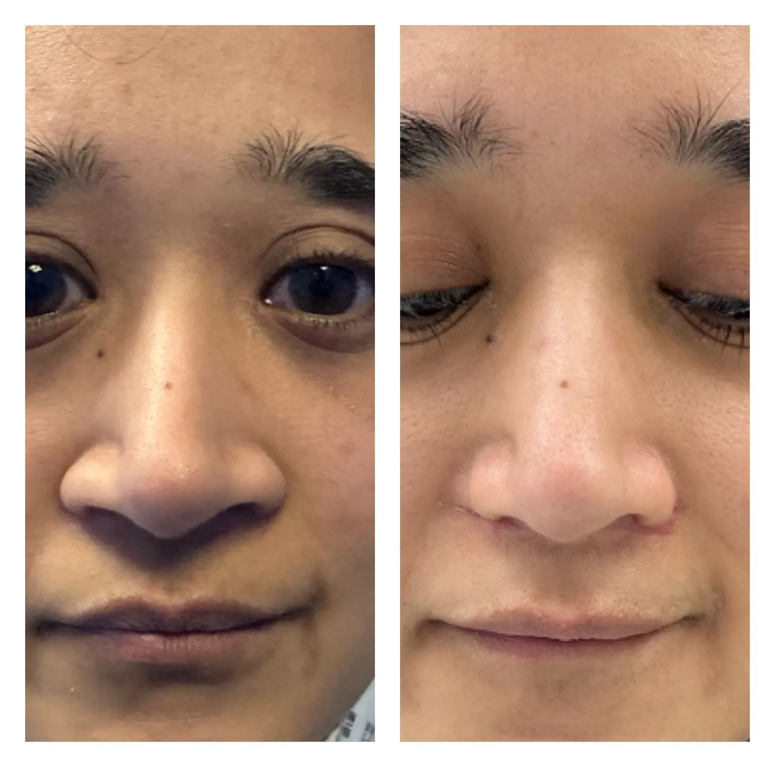 Rhinoplasty before and after result 7 by Dr Amr Khalil, Manchester