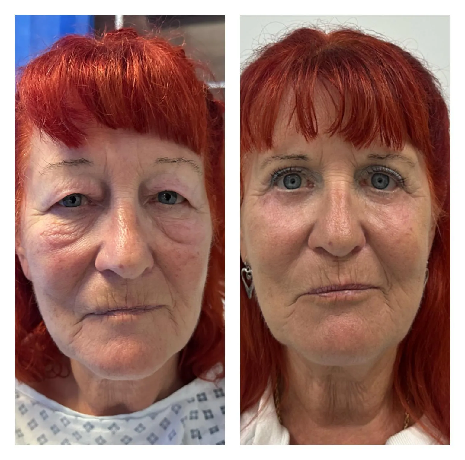 Upper & Lower Eyelids Lift before and after result 7 by Dr Amr Khalil, Manchester