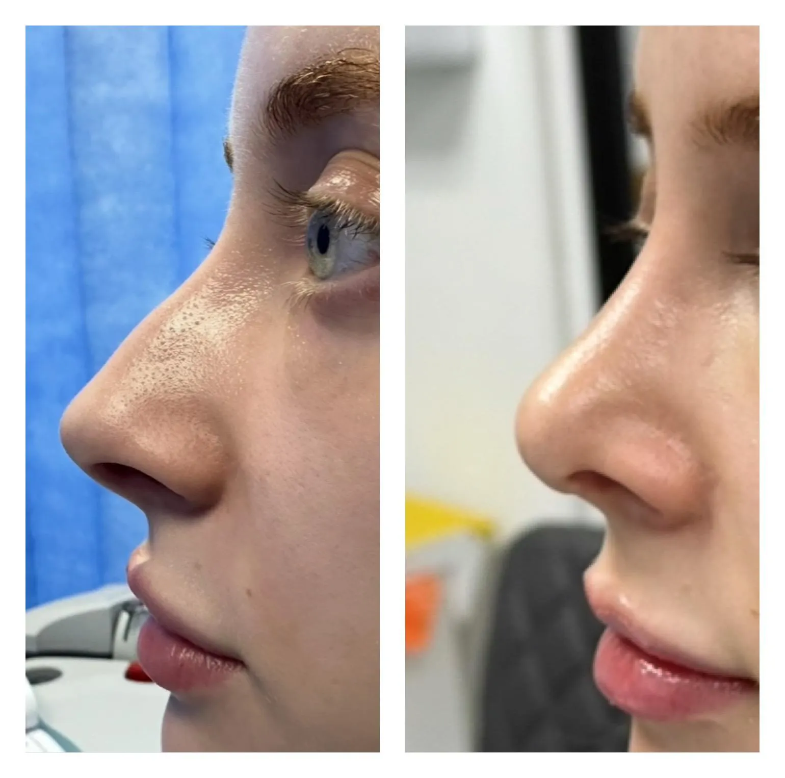 Rhinoplasty before and after result 9 by Dr Amr Khalil, Manchester