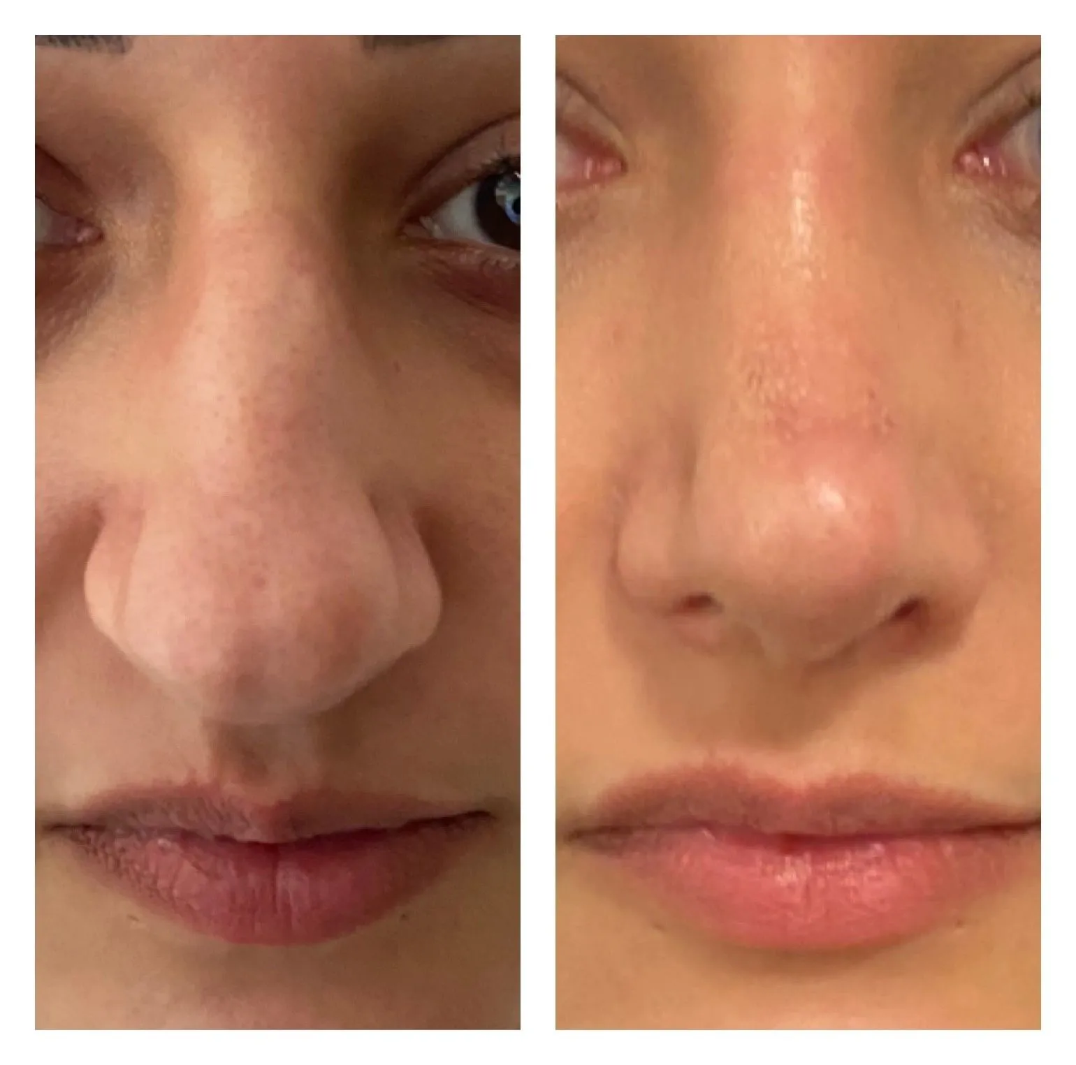 Rhinoplasty before and after result 10 by Dr Amr Khalil, Manchester