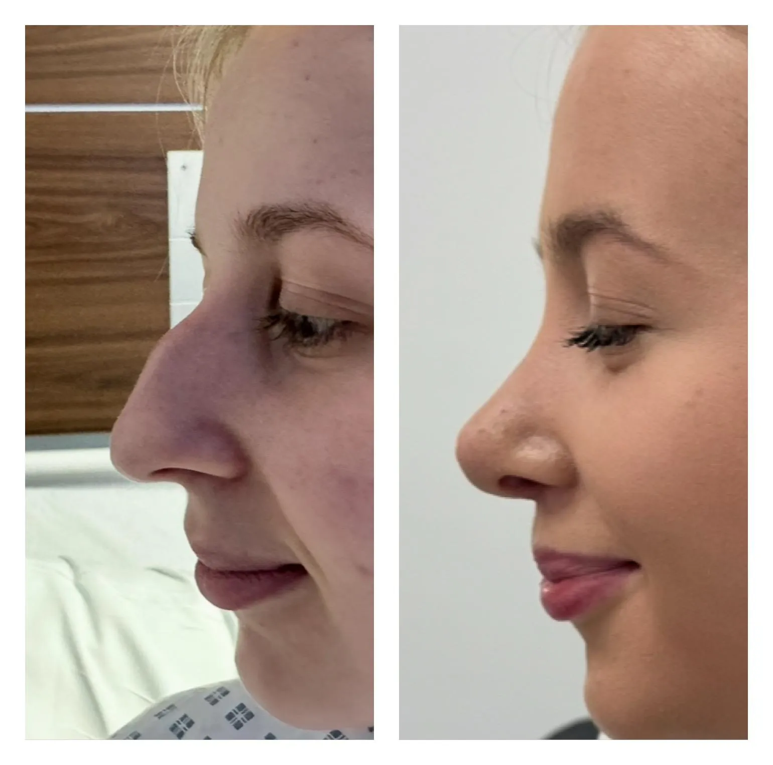 Rhinoplasty before and after result 11 by Dr Amr Khalil, Manchester