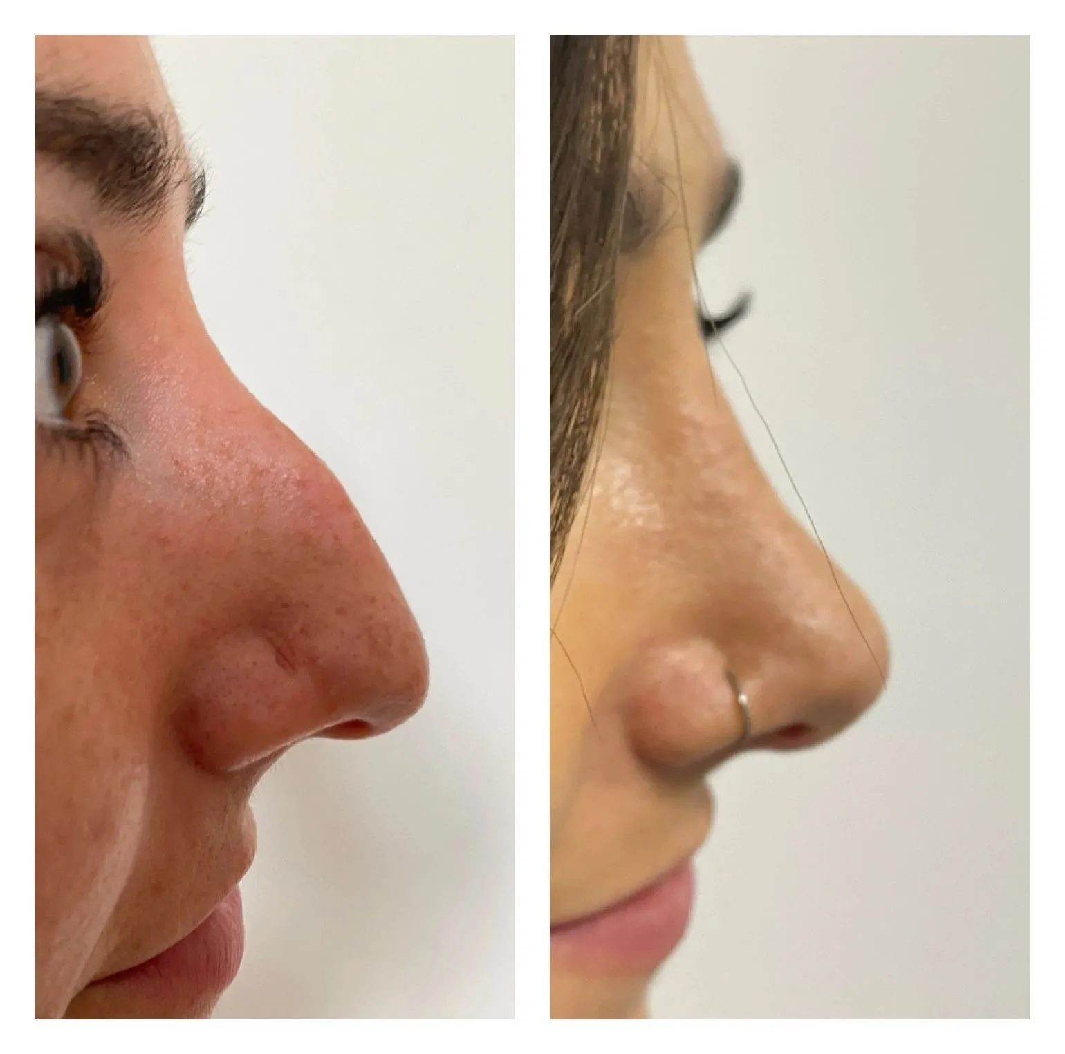 Rhinoplasty before and after result 12 by Dr Amr Khalil, Manchester
