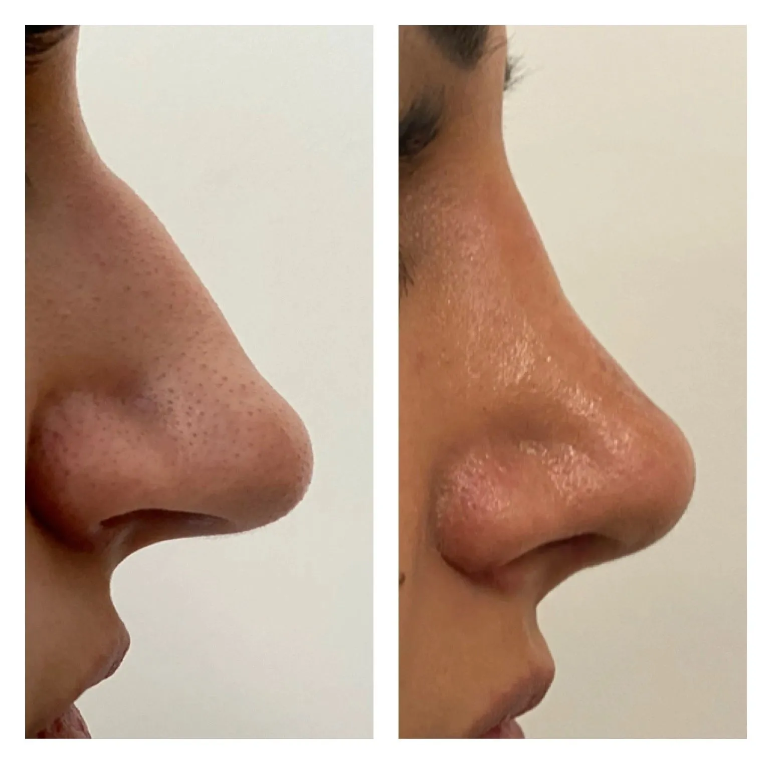 Rhinoplasty before and after result 13 by Dr Amr Khalil, Manchester