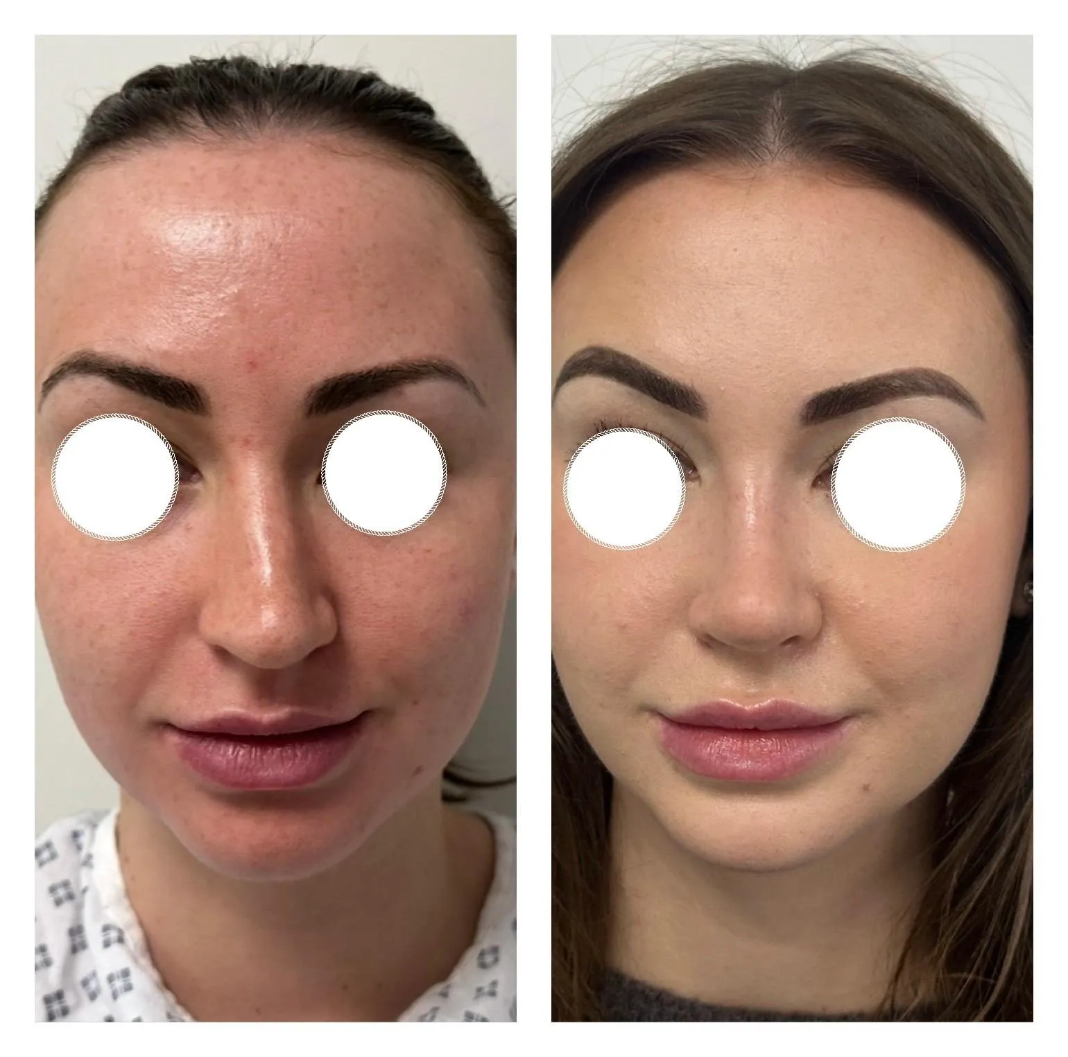 Rhinoplasty before and after result 14 by Dr Amr Khalil, Manchester