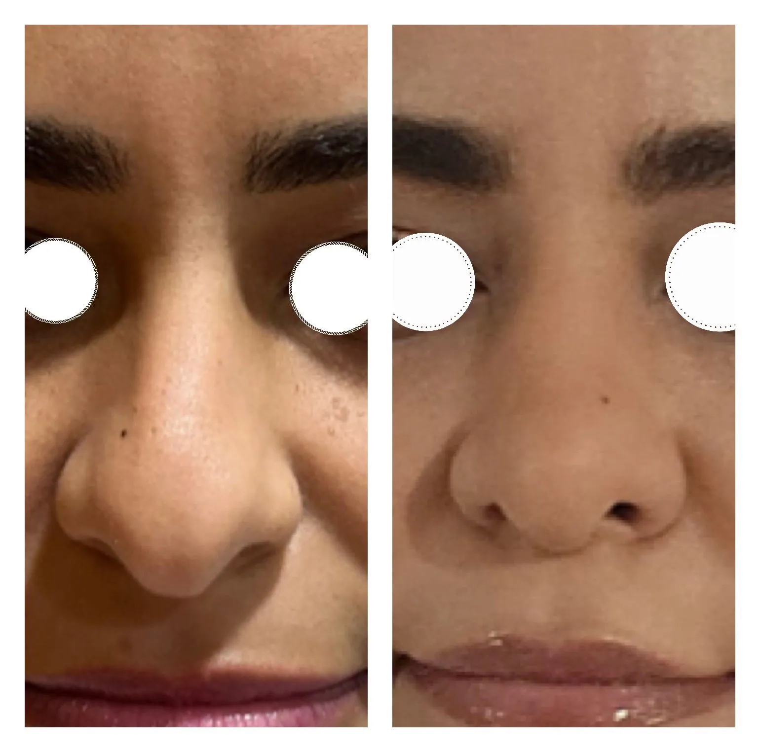 Rhinoplasty before and after result 15 by Dr Amr Khalil, Manchester