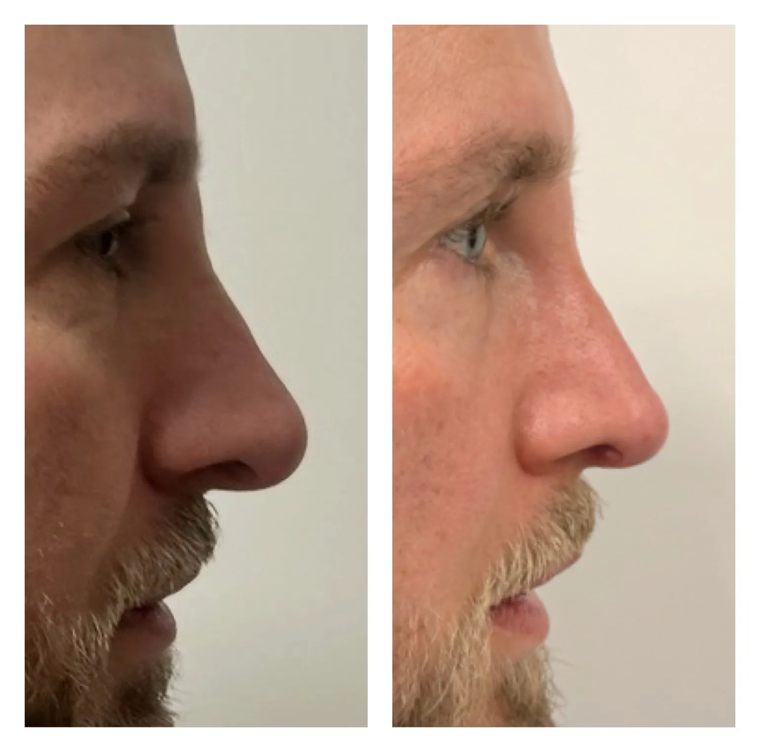 Rhinoplasty before and after result 16 by Dr Amr Khalil, Manchester